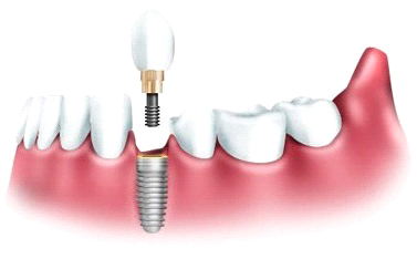 Имплантация зубов Томск Азербайджанская стоматология денталия отзывы